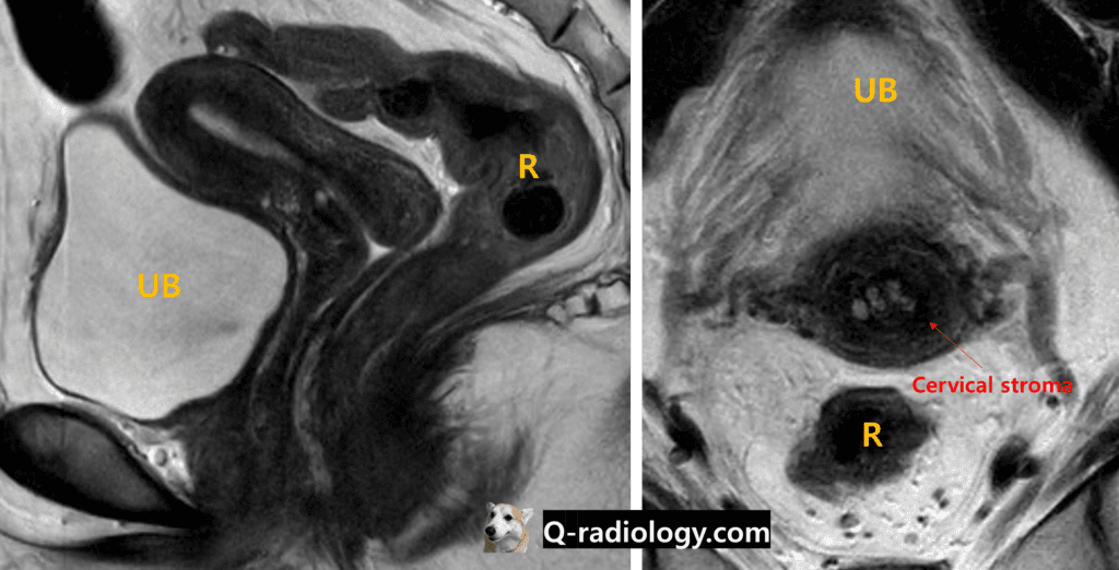 Normal anatomy of uterine cervix (MRI, T2 weighted image)
