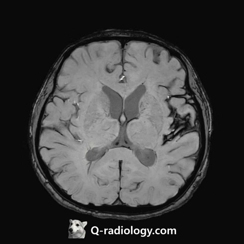 SWI : Diffuse hypointense rim along brain surface (Left > Right) 
