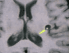 Neurocysticercosis MRI
Vesicular stage : Cyst with mural nodule(scolex or larva)