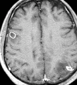 Granular nodular stage
rim enhancing pattern, cyst wall retracted (left occipital lobe)