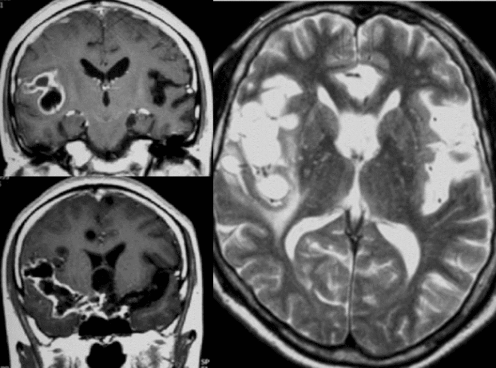 Cysticercosis at bilateral sylvian fissure (Racemose type) note that no mural nodule(scolex) not likely to cysticercosis in brain parenchyma