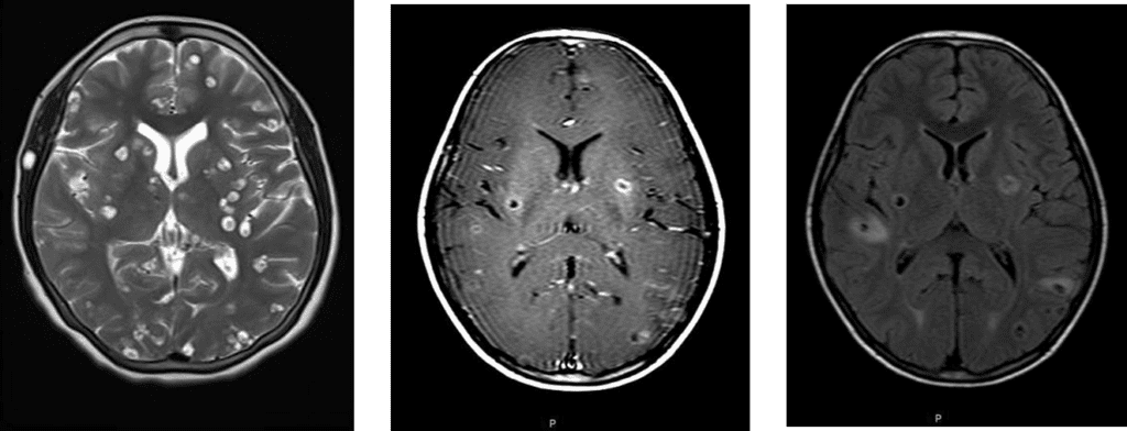 Typical neurocysticercosis 
