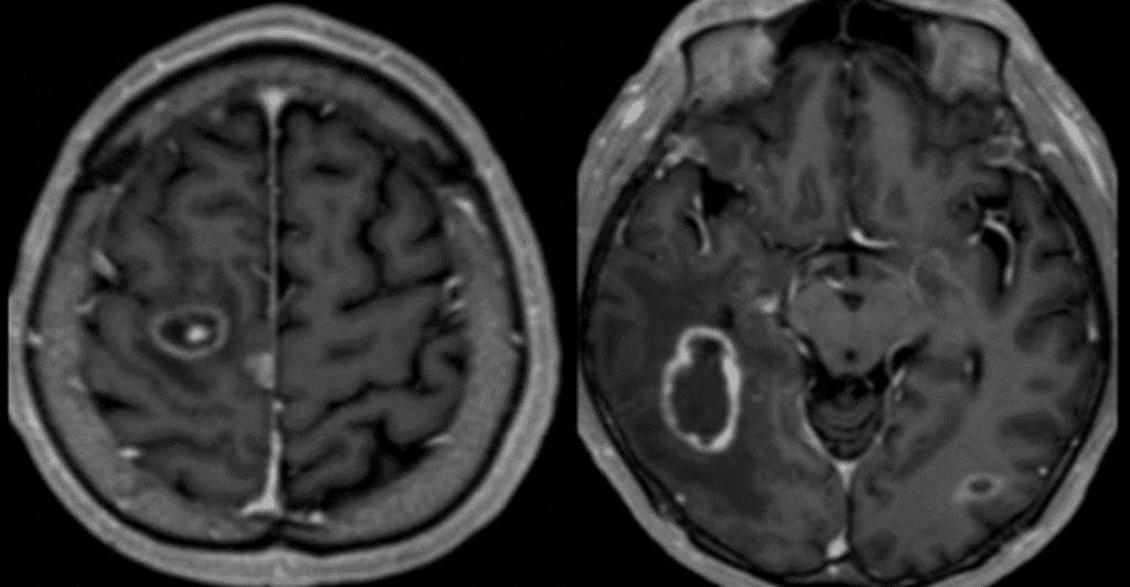 Toxoplasmosis in brain
T1CE : Eccentric target sign