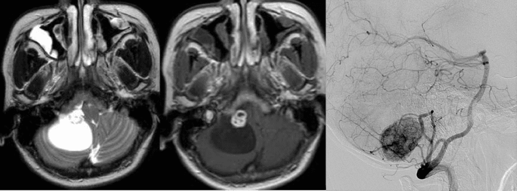 Cystic mass with strongly enhancing mural nodule in posterior fossa
Strong and persistent vascular blush of the tumor on angiography
