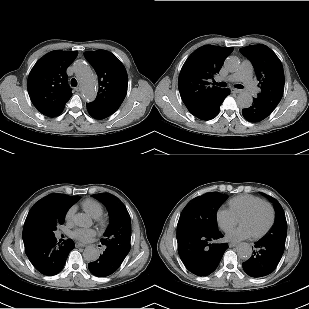 Takayasu arteritis precontrast CT
A 57 year-old man presented with substernal chest pain lasting 1 year Precontrast chest CT reveals diffuse wall thickening of aorta from aortic arch to descending aorta with calcifications