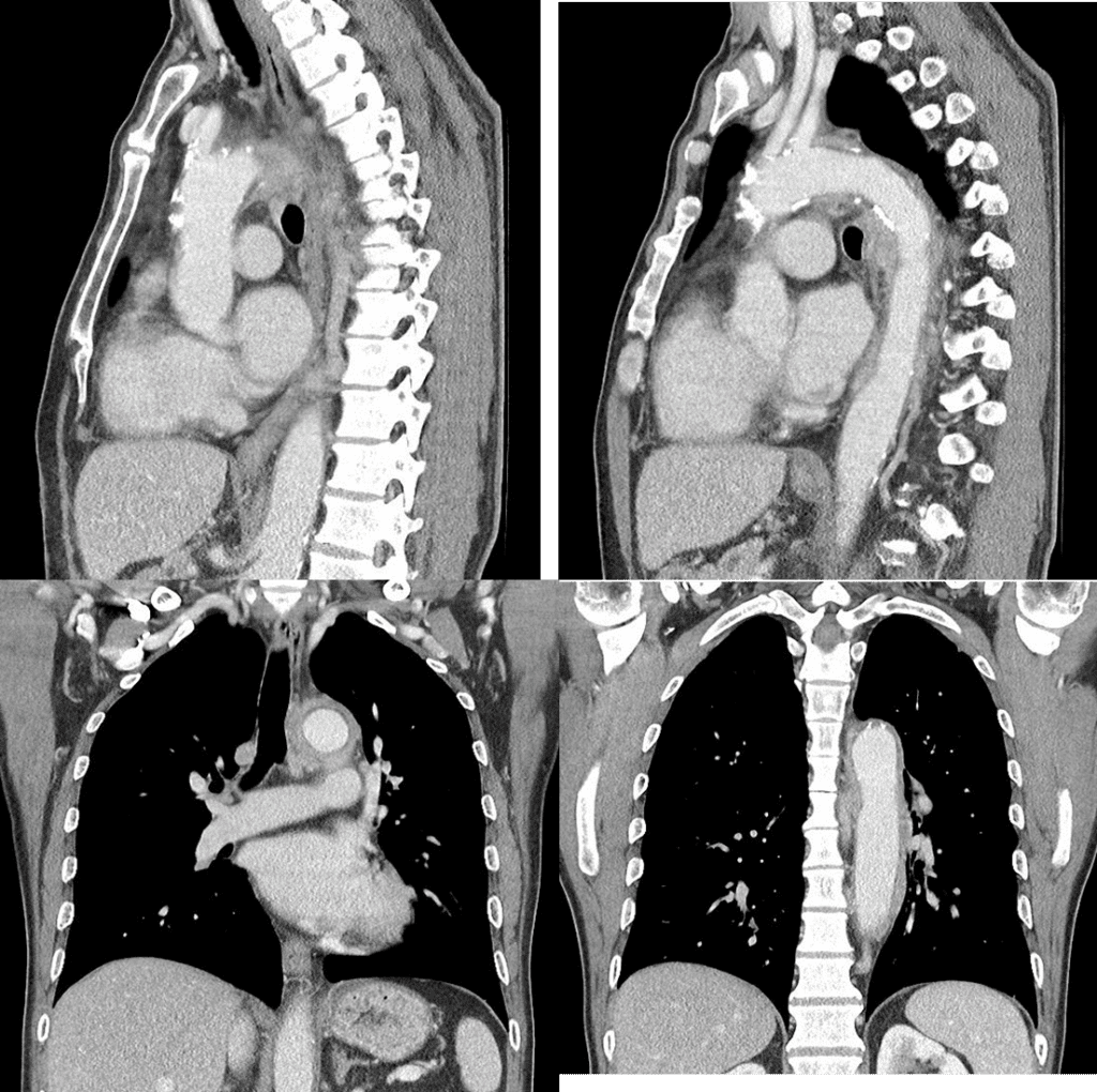 Sagittal and coronal view of the contrast enhanced CT scan
reveals diffuse wall thickening and enhancement of aorta.
