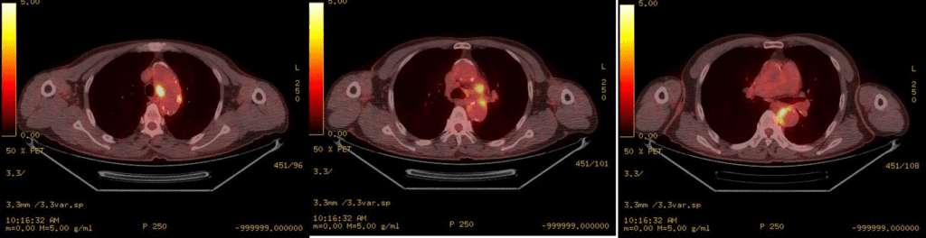 FDG/PET-CT 
Multifocal hypermetabolic lesions along the aortoc arch, descending thoracic aorta (SUVmax= 9.0), suggesting acute phase of the disease