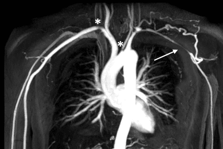 Multifocal narrowing of branches of the aorta in Takayasu arteritis.
Note that left subclavian artery shows long segmental stenosis (arrow)