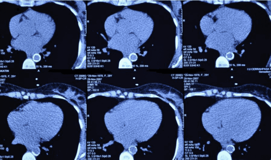 Transmural wall calcification involving descending aorta in chronic phase Takayasu arteritis patient.