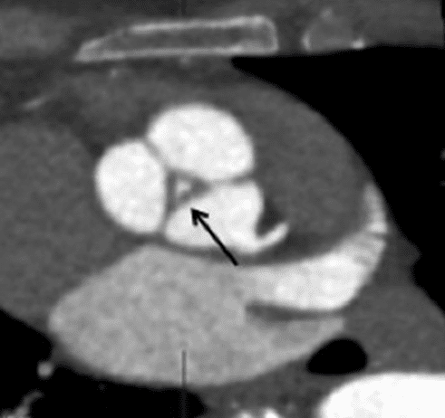 Regurgitation orifice at aortic valve
