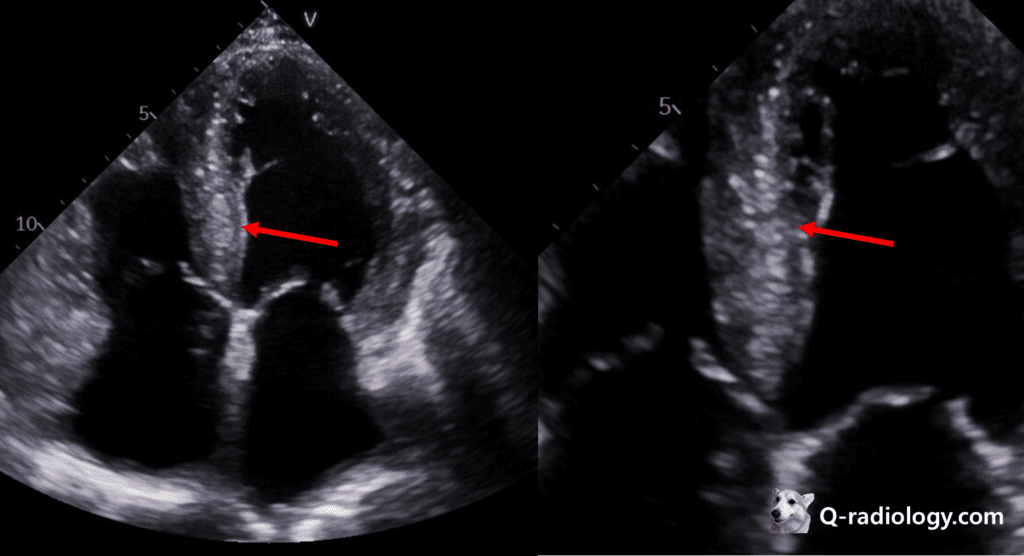 Cardiac amyloidosis ultrasound