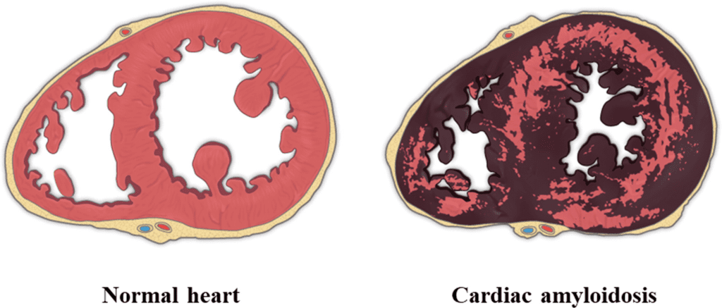 cardiac amyloidosis