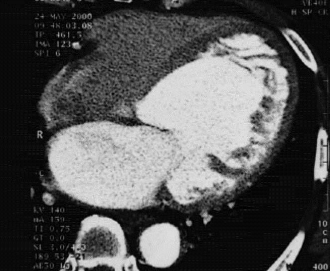 Left ventricular noncompaction cardiomyopathy