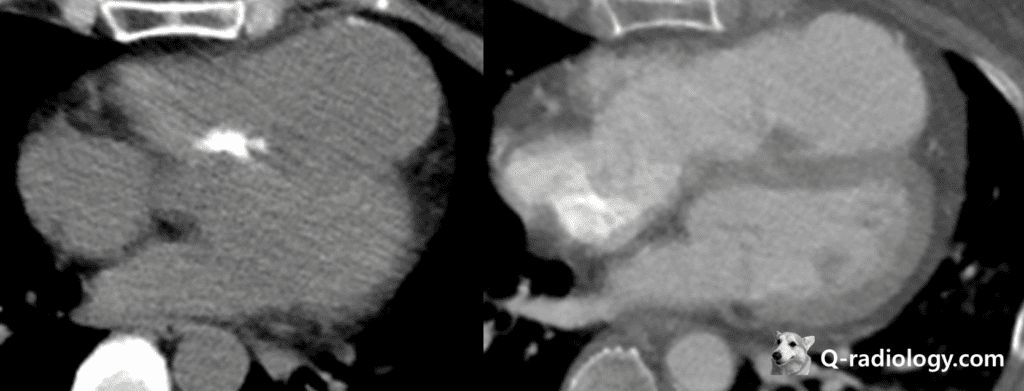 Arrhythmogenic right ventricular dysplasia