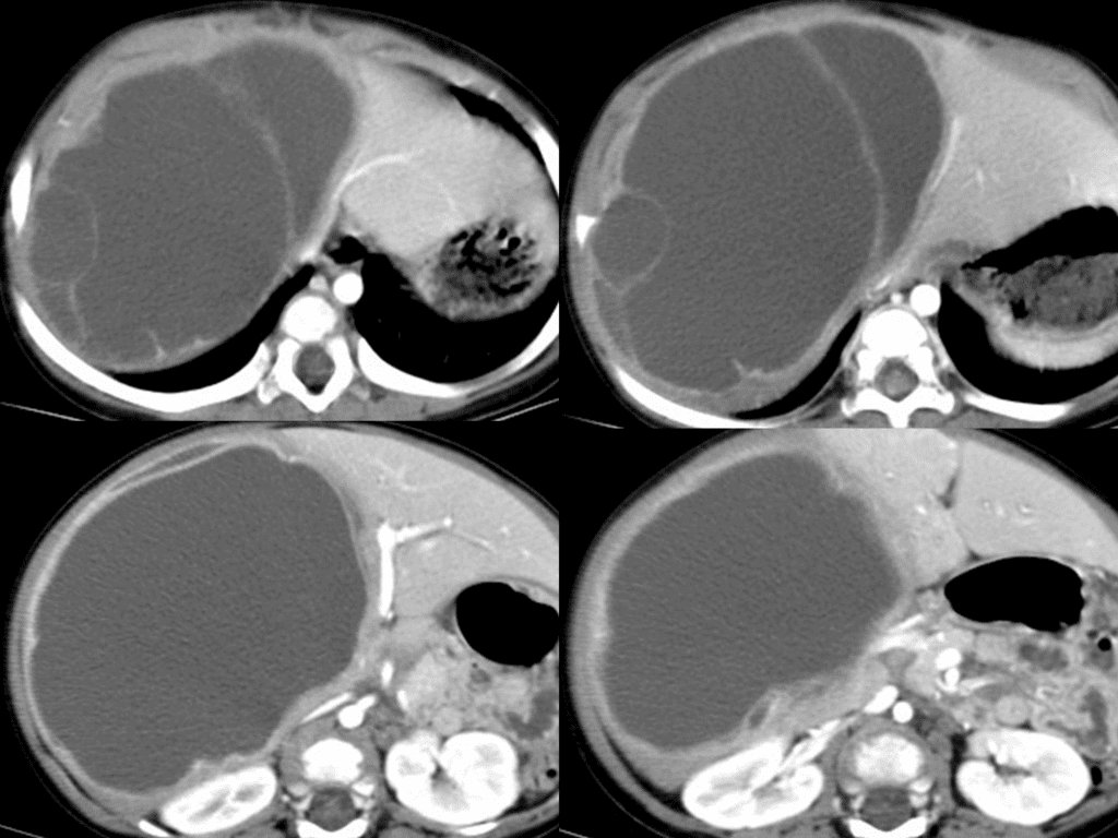 large multiloculated mass with variable septa and cystic spaces or mixed solid and cystic tumor