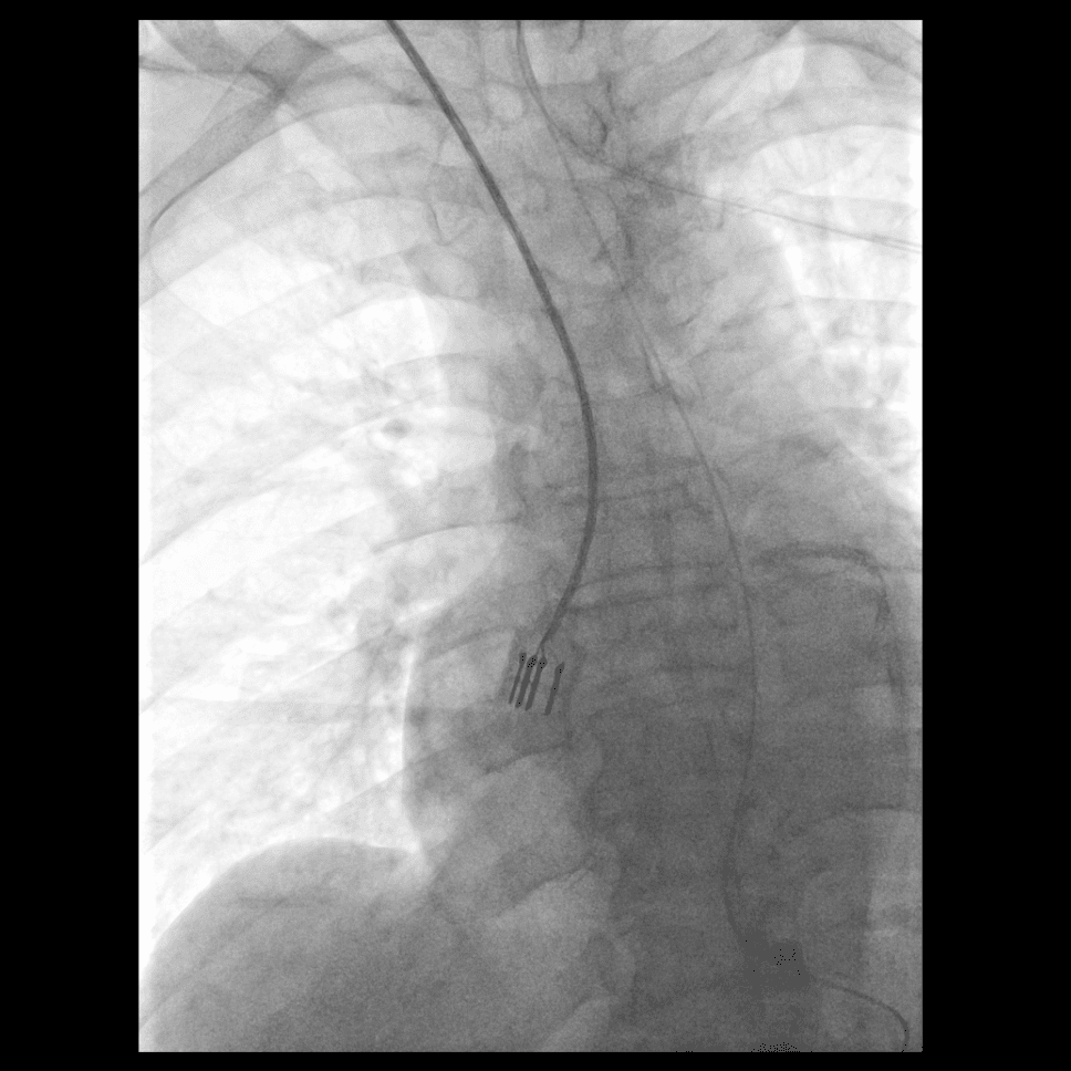 Today’s case 3 – PICC (peripherally inserted central catheter)
