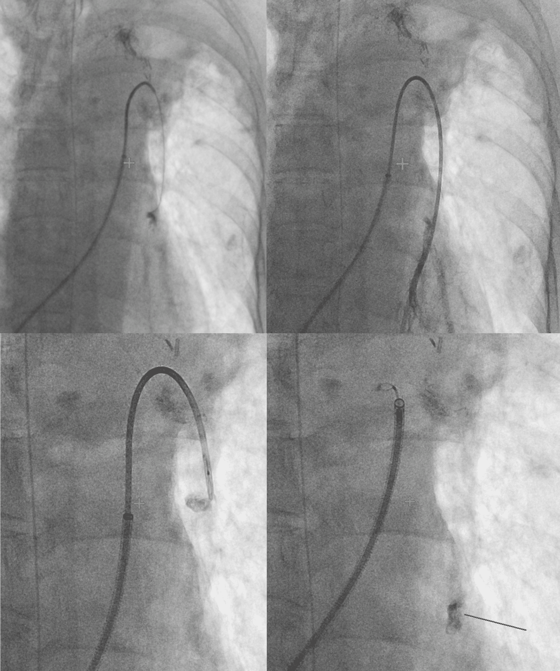 Today’s case 6 – Pulmonary artery aneurysm embolization (How to remove the glue cast which migrated into unwanted vessel)