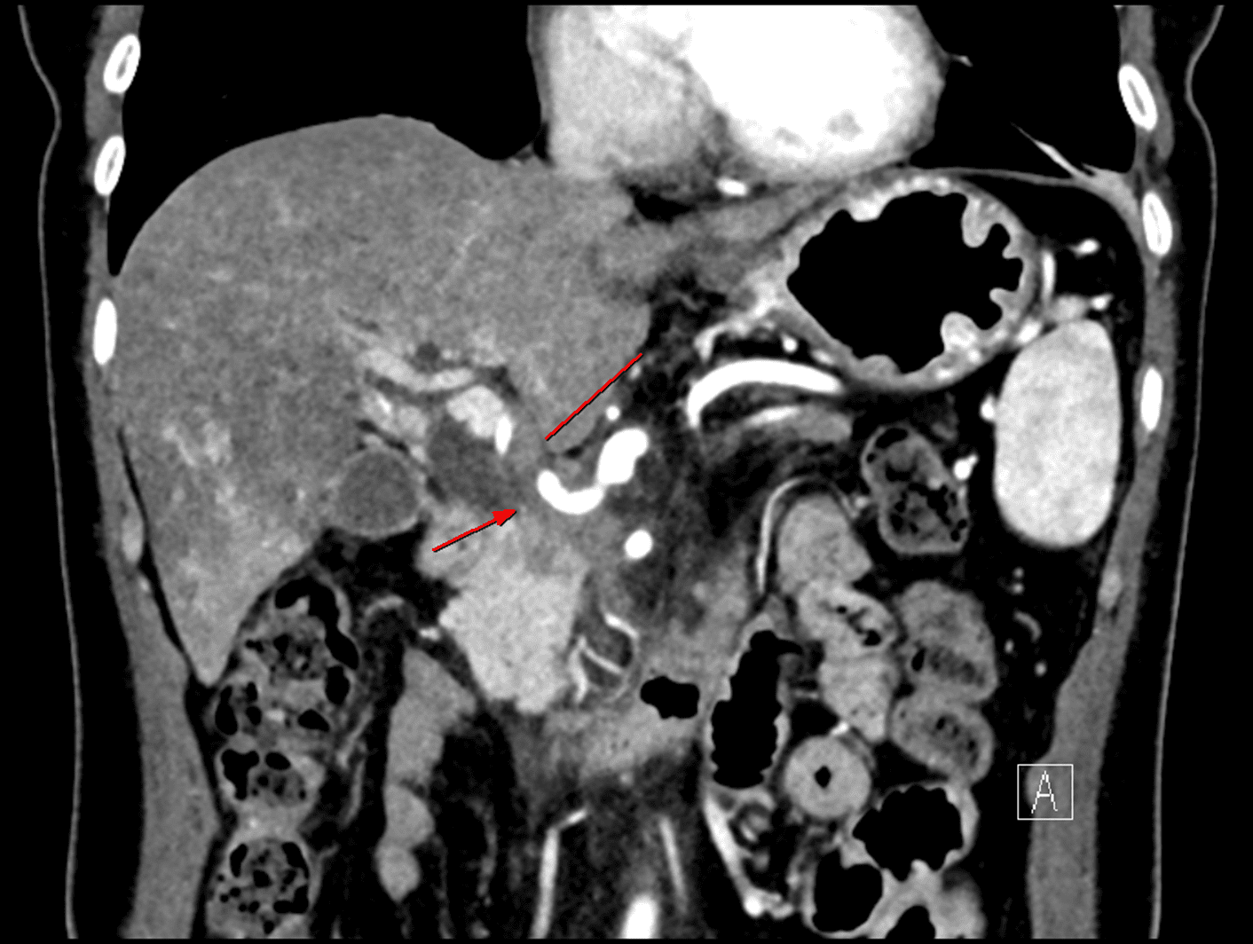 Today’s case 2 – Portal vein stent insertion for invaded main portal vein by pancreas head cancer