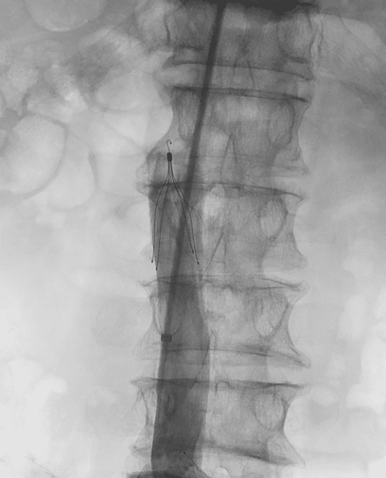 IVC filter in IVC center
