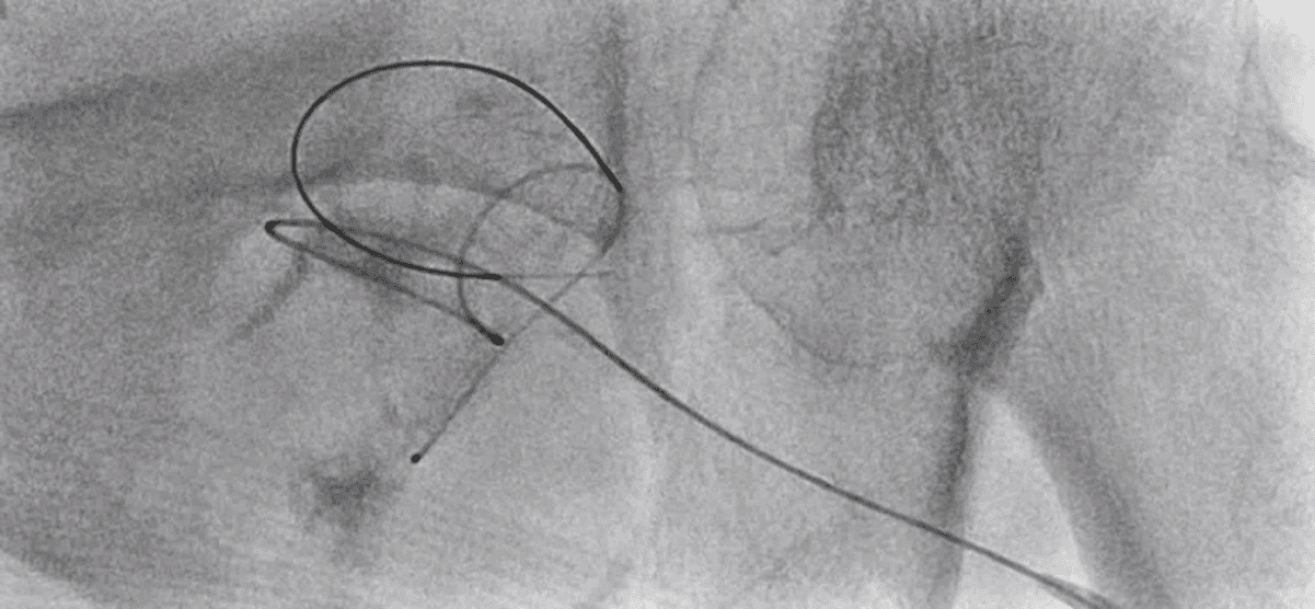 Today’s case 8 – Hair wire fracture during insertion of PCD
