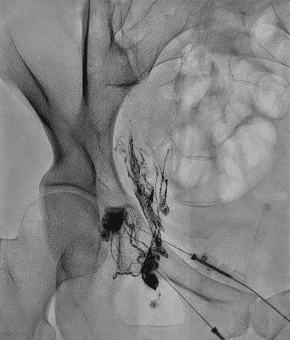 Thoracic duct embolization
