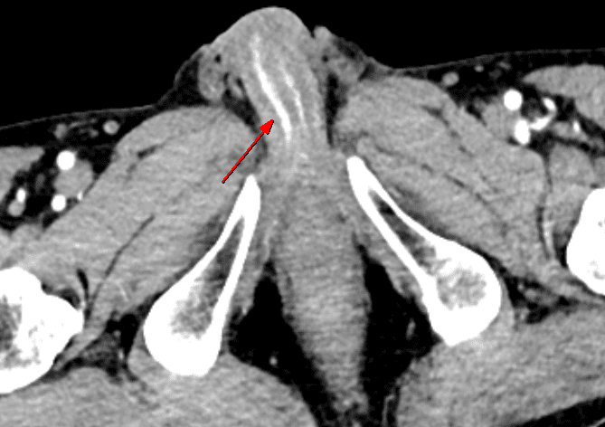 Today’s case 10 – Post traumatic high flow priapism