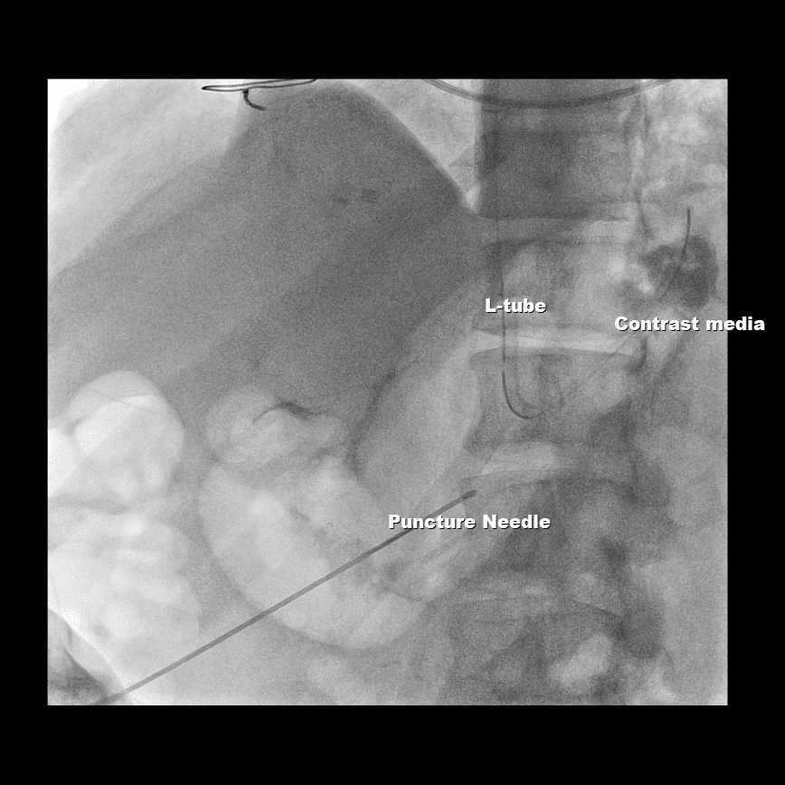 Percutaneous radiologic gastrostomy