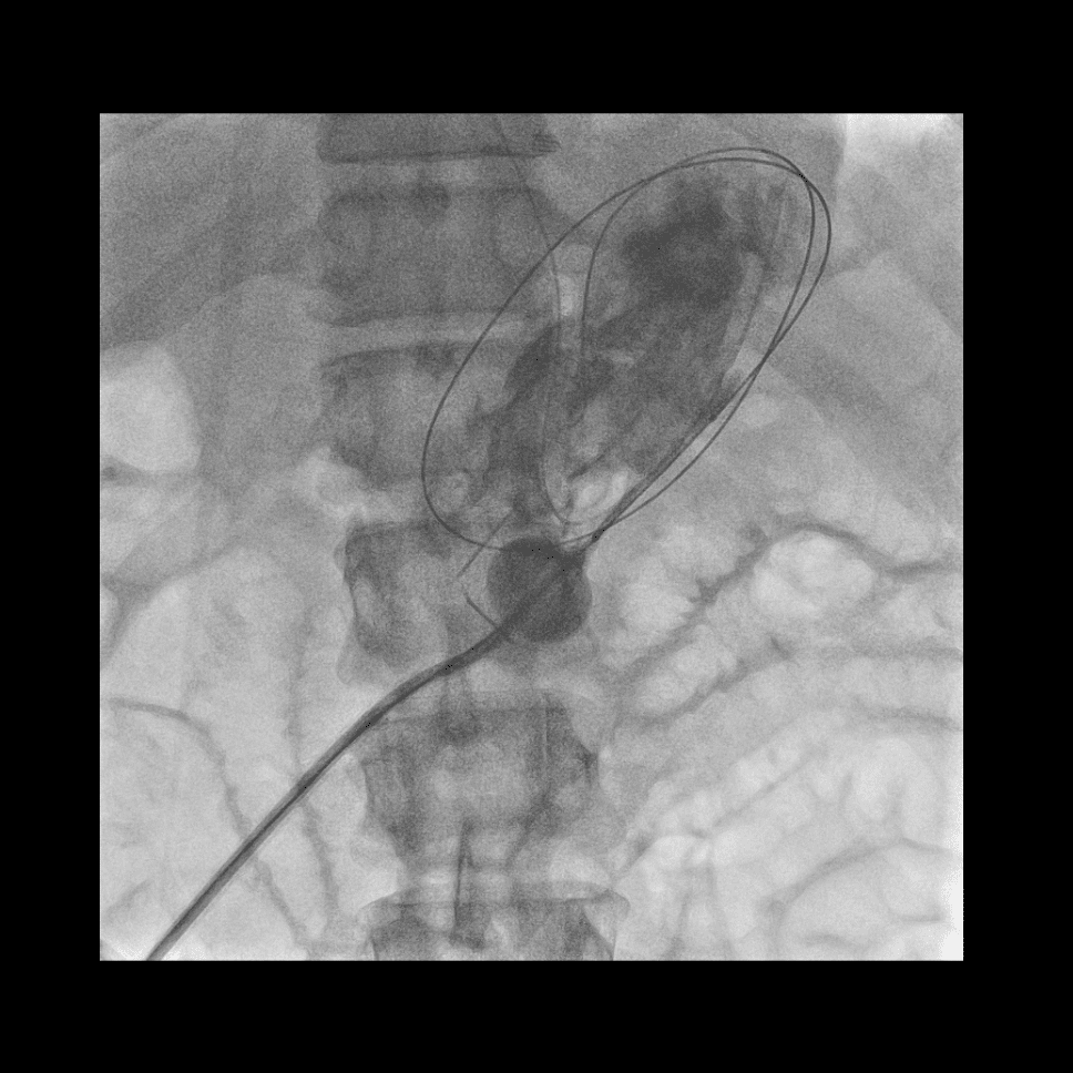 Case 14 : Percutaneous Radiologic Gastrostomy: Navigating Angles with Balloon Assistance